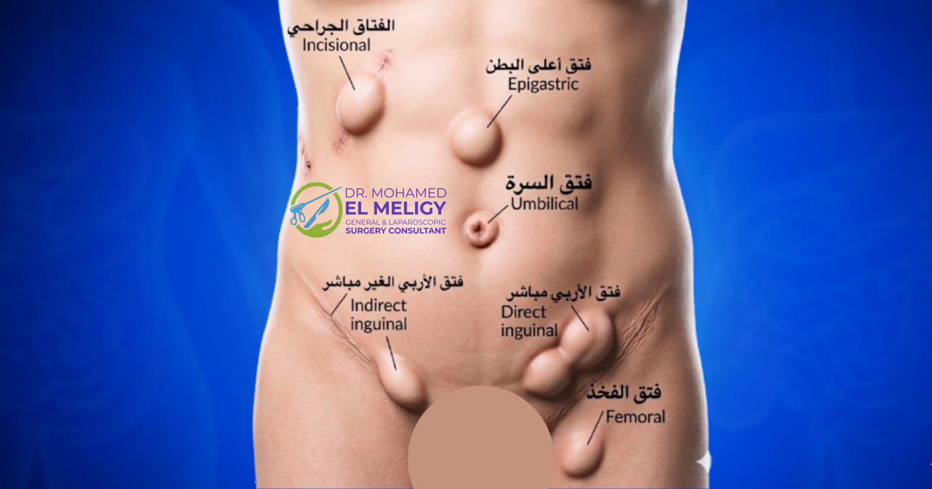 جراحات فتق جدار البطن